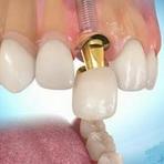 implantacija